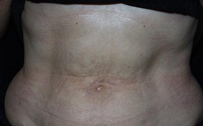 Abdomen After Needling